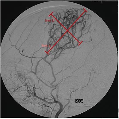 Recognition of the Effect of Indirect Revascularization for Moyamoya Disease: The Balance Between the Stage Progression and Neoangiogenesis